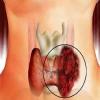рак щитовидной железы фото